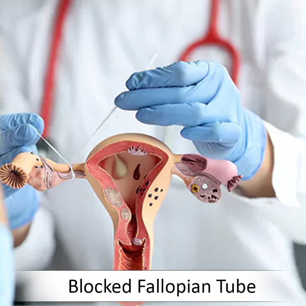 Blocked Fallopian Tube