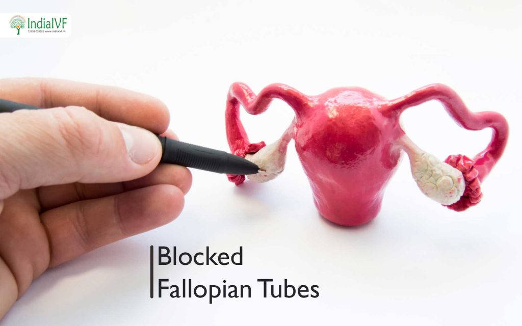 Blocked-Fallopian-Tubes