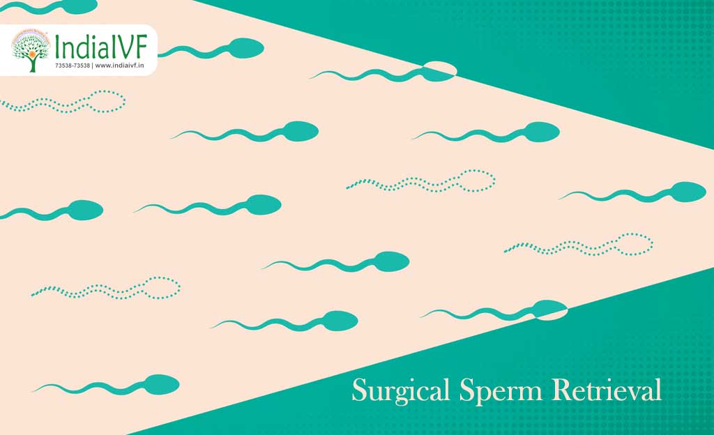 surgical-sperm-retrieval